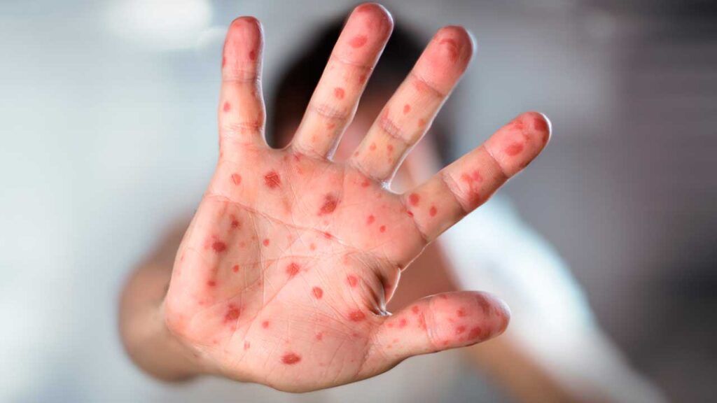 MiniSalud refuerza acciones preventivas ante aumento de casos de sarampión en las Américas