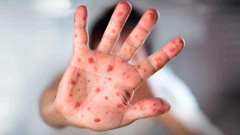 MiniSalud refuerza acciones preventivas ante aumento de casos de sarampión en las Américas