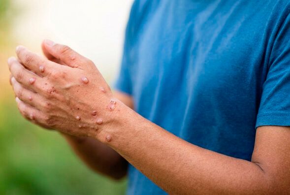 epidemia ed e1776797156252